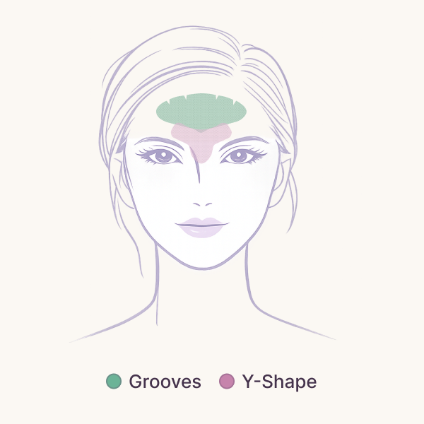 G9 Grooves and Y-Shape placement