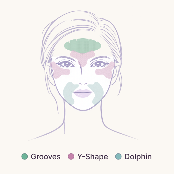 G15 Grooves, Y-Shape and Dolphin placement